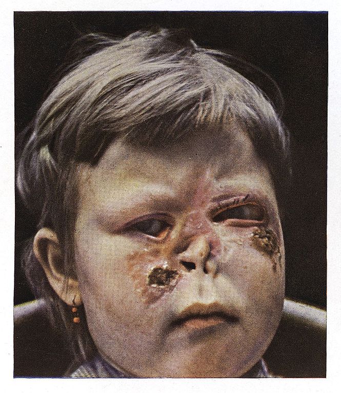 665px-a_girl_suffering_from_secondary_syphilis_to_the_face_wellcome_l0038266